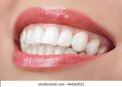 Teeth With Whitening Tray Smile Dental