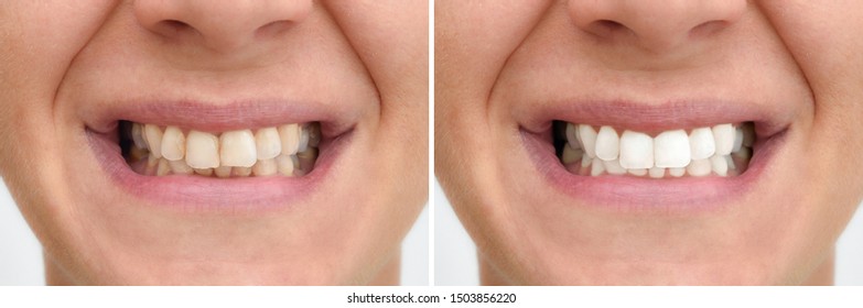 Teeth of a woman before and after correction and whitening