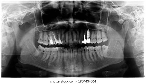 Teeth X-ray of an Adult with Cyst Surgery, Dental Root and Implant Treatments