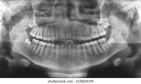 Teeth Xray Images Look Impacted Tooth Stock Photo 2150029199 | Shutterstock