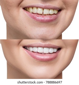 Teeth of young woman before and after whitening. - Shutterstock ID 788886697