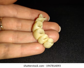Temporary plastic teeth (bridge) for front teeth before placing of dental crowns