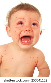Ten Month Old Baby Boy With Measles Crying. 