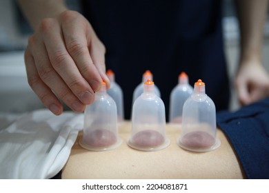 The Tense Muscles Are Loosened By The Traditional Korean Medicine Cupping