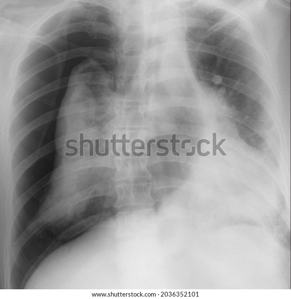 Tension Pneumothorax Chest X Ray Radiology Stock Photo 2036352101 ...