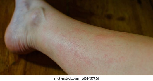 Schrecklich juckender Hautausschlag am Bein aus Rasieren ohne Rasiergel. 