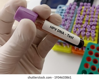 Test Tube With Blood Sample For  HPV DNA Test, Human Papilloma Virus, Cervical Cancer. A Medical Testing Concept In The Laboratory