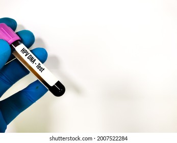 Test Tube With Blood Sample For HPV DNA Test, Human Papilloma Virus, Cervical Cancer. A Medical Testing Concept In The Laboratory