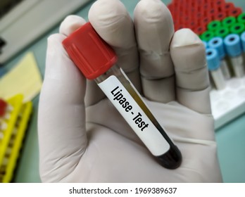 Test Tube With Blood Sample For Pancreatic Enzyme Test. Amylase, Lipase Test
