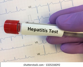 Test Tube For Hepatitis Virus Blood Testing