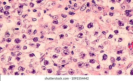 Testicular Cancer: Photomicrograph Of Seminoma, A Malignant Germ Cell Tumor Of The Testis (testicle).  It Has A Survival Rate Of 95%