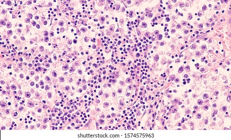 Testicular Cancer: Photomicrograph Of Seminoma, A Malignant Germ Cell Tumor Of The Testis (testicle).  It Has A Survival Rate Of 95%