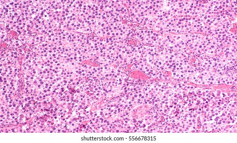 Testicular Cancer: Photomicrograph Of Seminoma, A Malignant Germ Cell Tumor Of The Testis (testicle).  It Has A Survival Rate Of 95%