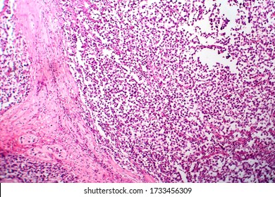 Testicular Seminoma, Light Micrograph, Photo Under Microscope. A Most Common Germ Cell Tumor Of The Testis