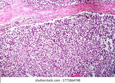 Testicular Seminoma, Light Micrograph, Photo Under Microscope. A Most Common Germ Cell Tumor Of The Testis