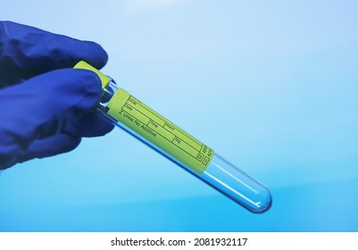Test-tube for taking urine in a doctor's hand in medical glove on blue medical background. Empty test-tube, plastic biomaterial container. Urine test. Urine analysis.