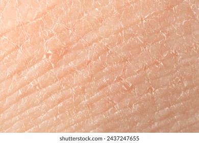 Texture of dry skin as background, macro view