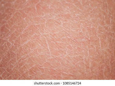 Texture Of Human Skin Large With Dermatological Problems Of Dryness And Cracking