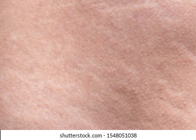 Texture of human's body with the stretch marks, closeup photo