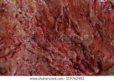 texture of the removed tumor macro