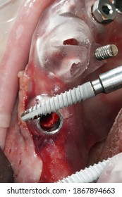 Textured Implant Before Implantation Through A Surgical Template