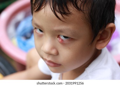 Thai Bay Had External Hordeolum (Stye) At Left Eye