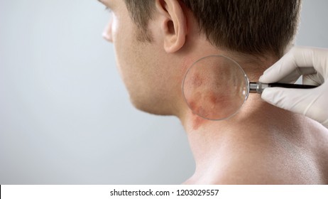 Therapist Examines Rash On Patient Neck With Magnifying Glass, Dermatology