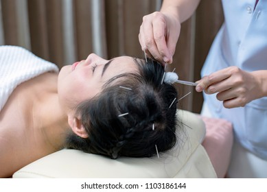 Therapist Giving acupuncture treatment needle on the head for Hair transplant  treatment at the health spa; acupuncturist doctor makes a therapy for asian young woman at asian beauty clinic.