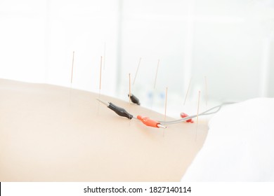 Therapy of female body with pricking acupuncture needles and electric stimulation