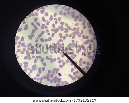 There are two main types of malaria parasites, Plasmodium falciparum and Plasmodium vivax. Plasmodium falciparum often causes malignant malaria