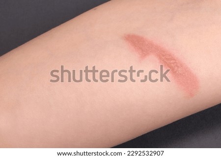 Thermal burn on human skin close up, home accident