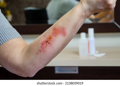 Thermal Burn Of The Skin In The Healing Stage. Burnt Skin On A Woman's Hand, Household Injury From Boiling Water, Close-up. Second Degree Burn. Selective Focus