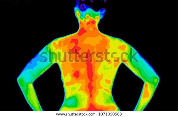 Thermographic photo of back of upper body\
of a woman with photo showing different temperature in a range of\
colors from blue showing cold to red showing hot which can indicate\
joint\
inflammation.