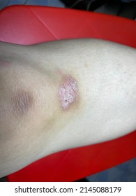 Thicker And Dry Skin At The Knee. Dead Skin Cells Concept. 