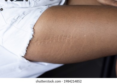 Thigh Of Black African Woman With Surgery Keloid Scar, Upper Leg Orthopedics Operation Concept