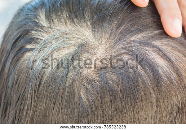 Thin Hair Dandruff Royalty Free Stock Image