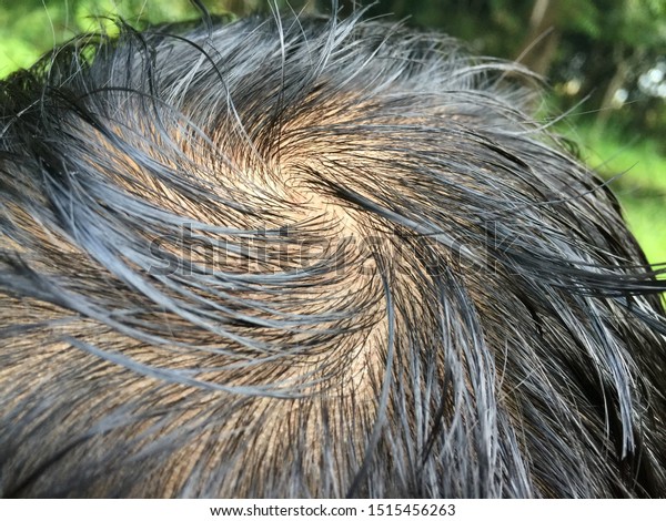 Thin Hair Oily Scalp Men Stock Photo Edit Now 1515456263