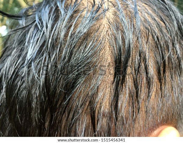 Thin Hair Oily Scalp Men Stock Photo Edit Now 1515456341