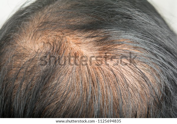 Thin Hair Scalp Broken Hair Stock Photo Edit Now 1125694835