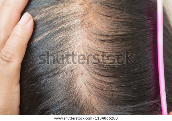 Thin Hair Scalp Broken Hair Stock Image Download Now