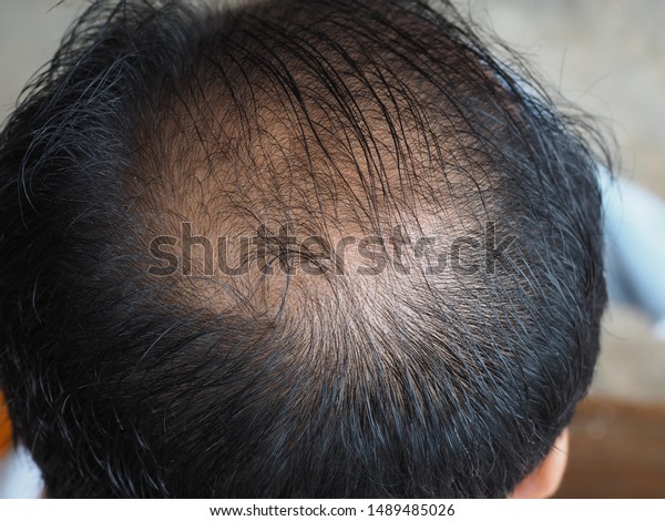Thin Hair Scalp Broken Hair Stock Photo Edit Now 1489485026