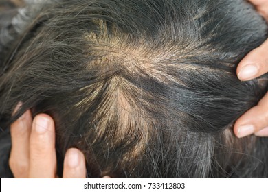 Thin Hair In Women