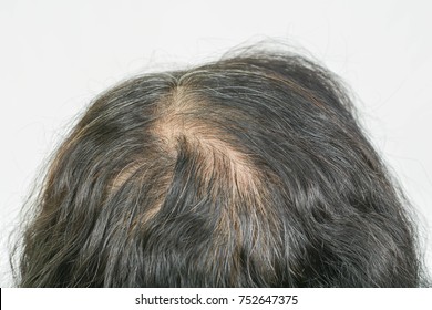 Woman Thinning Hair Images Stock Photos Vectors Shutterstock