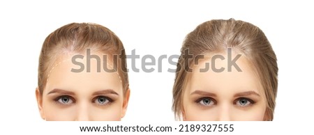 Thinning hair and hair loss,female pattern baldness,Hair transplant
