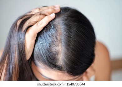 Thinning Hair And Scalp Issue Hair Loss Treatment Head With Loss Dymptoms.