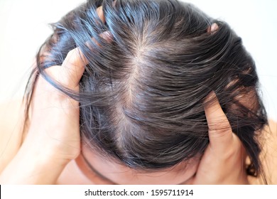 Thinning Hair Scalp Issue Hair Loss Treatment Head With Loss Symptoms.