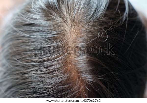 Thinning Hair Sealp Issue Hair Loss Beauty Fashion Healthcare