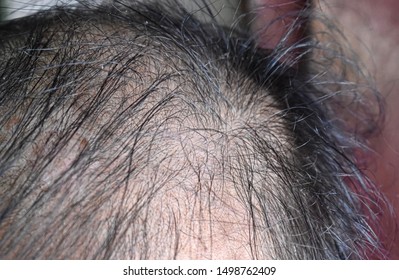 3,761 Sparse hair Images, Stock Photos & Vectors | Shutterstock