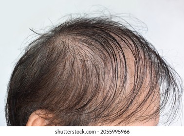 Thinning Or Sparse Hair, Male Pattern Hair Loss In Southeast Asian, Chinese Elder Man.