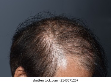 Thinning Sparse Hair Male Pattern Hair Stock Photo 2148871269 ...